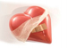 Dèficit de ferro en pacients amb insufìciència cardíaca: avenços en el tractament per la millora dels símptomes i qualitat de vida